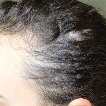 Antes