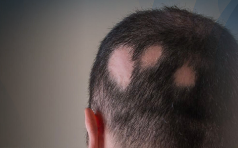 Alopecia areata em homem, um tipo de alopecia rara