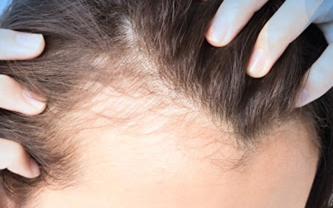 Alopecia frontal fibrosante tratamento