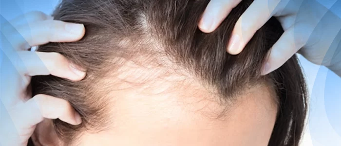 Alopecia frontal fibrosante tratamento