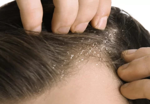 Dermatite seborreica causa queda de cabelo