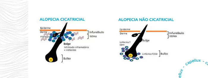 Tipos de alopecia . Alopecia cicatricial e alopecia não cicatricial